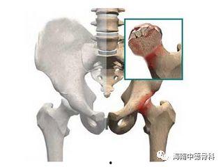 明星股骨头坏死,明星患者背后的健康警示